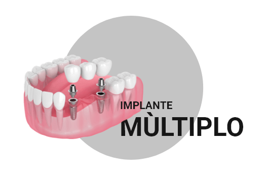 implante multiplo