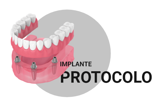 implante protocolo