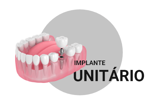 implante unitario